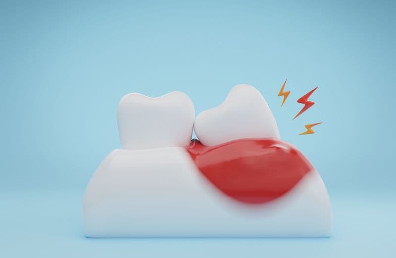 Why Do Wisdom Teeth Need To Be Removed?