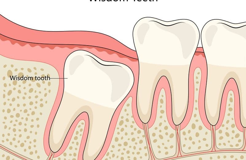 What to Eat After Wisdom Tooth Removal