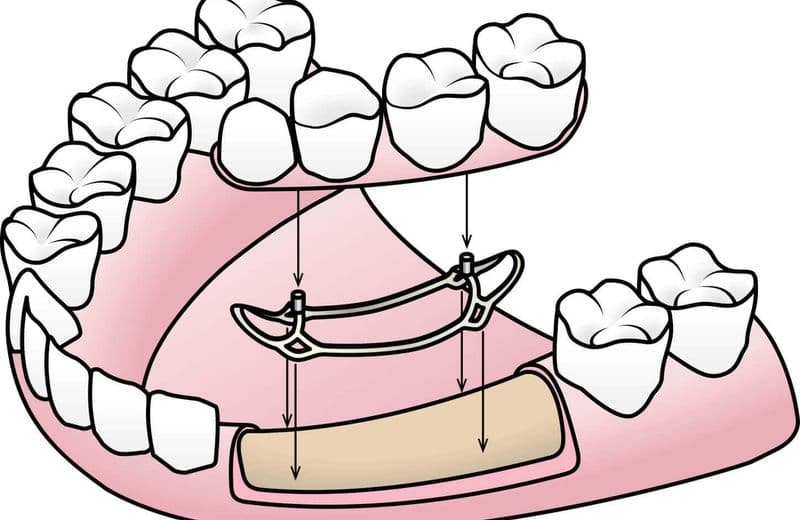 What are the Different Types of Dental Implants?