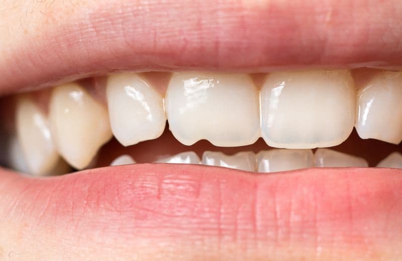 How to Repair a Chipped Tooth: Treatment Options, Costs & Care