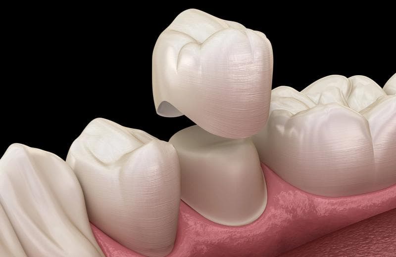 Dental Crowns: Procedure, Costs And What To Expect