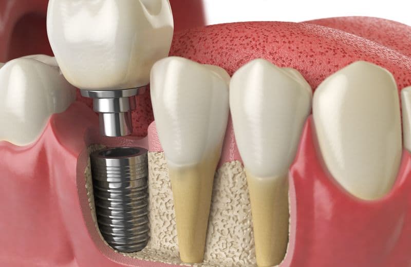 How to Prevent Side Effects of Dental Implants