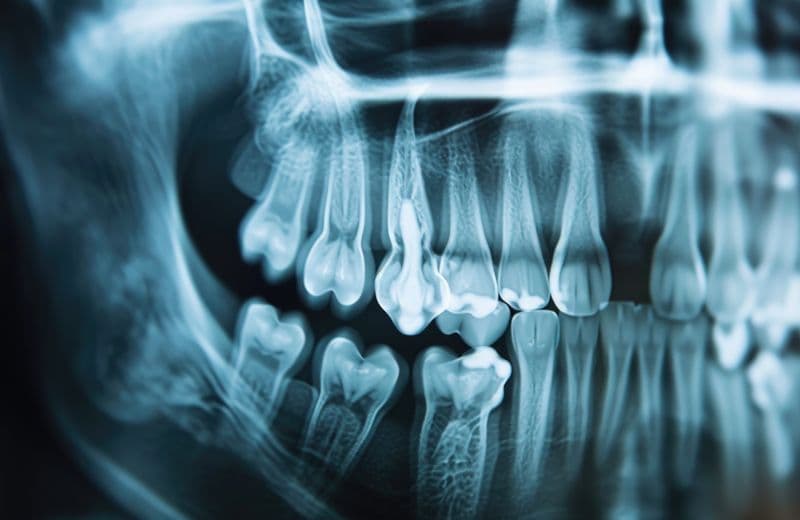 Options to Replace Missing Teeth with Dentures, Implants & More