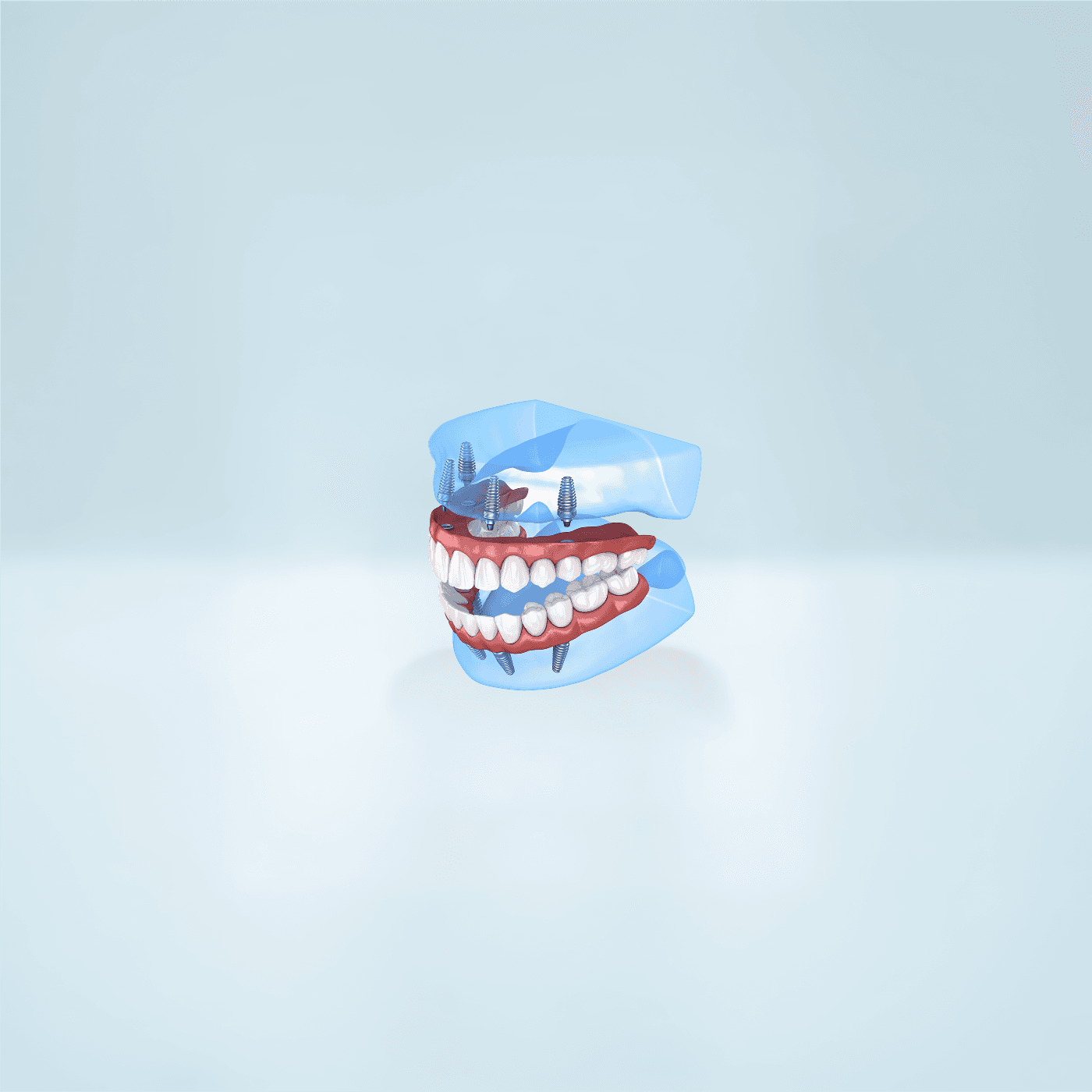 SnapeSecure Implants